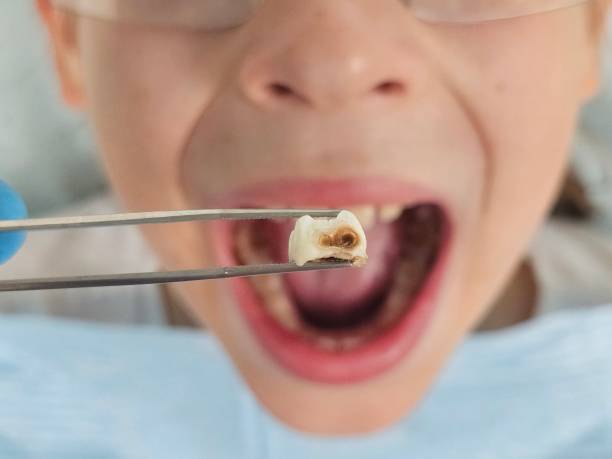 Best Emergency Broken Tooth Repair in Woodson Terrace, MO